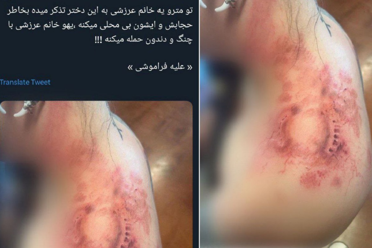 عکس| واقعیت ماجرای گاز گرفتن دختر بی حجاب توسط آمر به معروف در مترو عکس| واقعیت ماجرای گاز گرفتن دختر بی حجاب توسط آمر به معروف در مترو | دیلی فوتبال