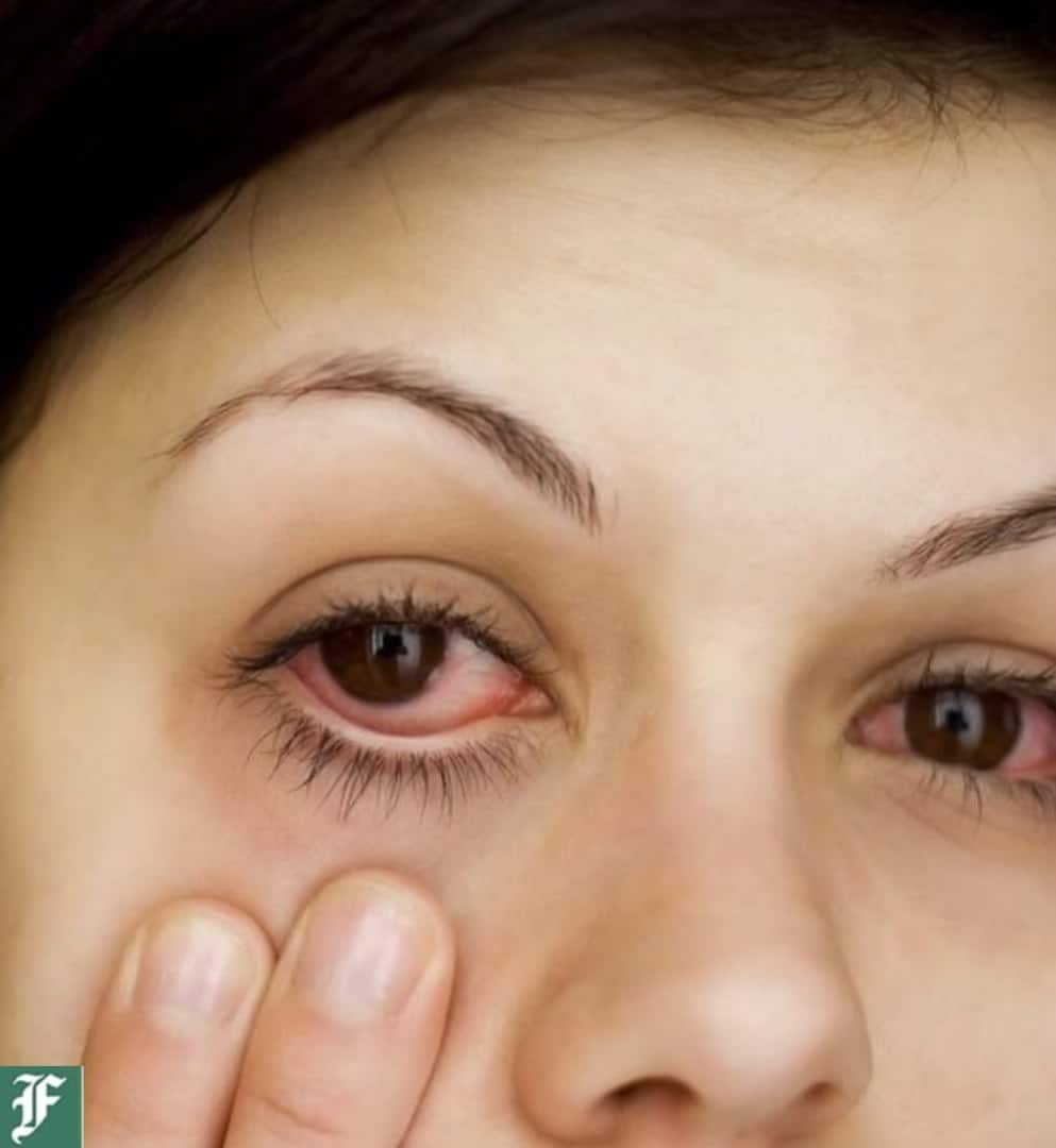 مهمترین علل خارش چشم و راه‌های درمان | دیلی فوتبال