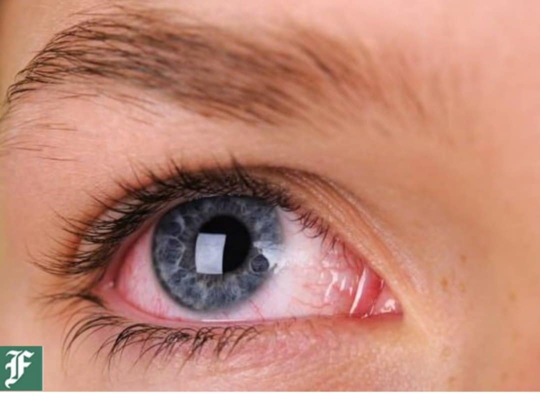 مهمترین علل خارش چشم و راه‌های درمان | دیلی فوتبال