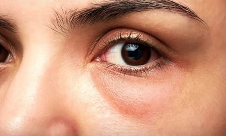 شش راهحل برای از بین بردن پف و تیرگی زیر چشم پف چشم