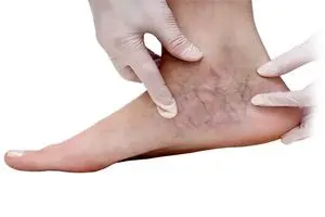 وقتی پاها بیماری را لو می‌دهند؛ این علائم را جدی بگیرید | دیلی فوتبال