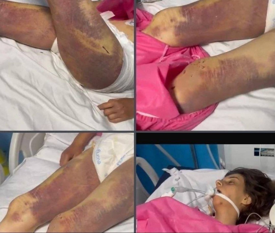 عکس (16+)| تصاویر دردناک نیلوفر مجاور؛ روایت هولناک از پرونده دختر پیرانشهری | دیلی فوتبال